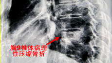 瑞康医院骨脊柱科完成一例胸椎转移瘤切除椎管环形减压钛笼植入脊柱内固定术