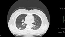 一附院首例完全胸腔镜肺癌根治手术成功