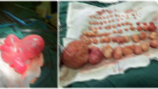 瑞康医院：74个肌瘤住在她的子宫 而她竟然以为是怀孕