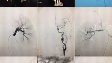 一附院成功救治一例动脉肌纤维发育不良高血压患者