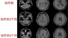 附属瑞康医院：六旬老伯脑内惊见25个肿瘤射波刀助力化险为夷