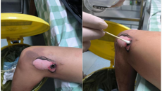 救治意外伤害 守护百姓春节安康丨一附院四肢骨伤科救治爆竹伤一例记实