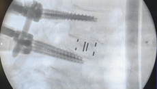 党建引领 提升服务——附属国际壮医医院外科第三党支部张文捷团队协助防城港市中医医院开展首例OLIF手术